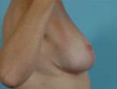 Patient # 16733 After Photo # 6